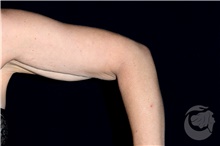Arm Lift Before Photo by Landon Pryor, MD, FACS; Rockford, IL - Case 40104