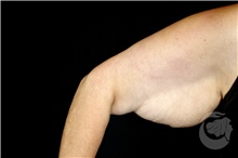 Arm Lift Before Photo by Landon Pryor, MD, FACS; Rockford, IL - Case 40106