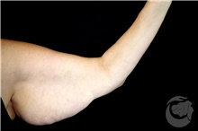 Arm Lift Before Photo by Landon Pryor, MD, FACS; Rockford, IL - Case 40106