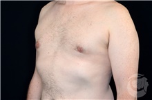 Male Breast Reduction After Photo by Landon Pryor, MD, FACS; Rockford, IL - Case 40108