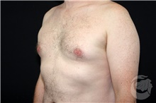 Male Breast Reduction Before Photo by Landon Pryor, MD, FACS; Rockford, IL - Case 40108