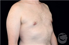 Male Breast Reduction After Photo by Landon Pryor, MD, FACS; Rockford, IL - Case 40108