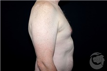 Male Breast Reduction Before Photo by Landon Pryor, MD, FACS; Rockford, IL - Case 40108