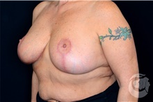 Breast Reduction After Photo by Landon Pryor, MD, FACS; Rockford, IL - Case 40110