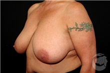 Breast Reduction Before Photo by Landon Pryor, MD, FACS; Rockford, IL - Case 40110