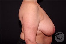 Breast Reduction Before Photo by Landon Pryor, MD, FACS; Rockford, IL - Case 40110