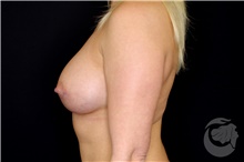 Breast Augmentation After Photo by Landon Pryor, MD, FACS; Rockford, IL - Case 40111