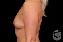 Breast Augmentation Before Photo by Landon Pryor, MD, FACS; Rockford, IL - Case 40111