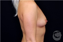 Breast Augmentation Before Photo by Landon Pryor, MD, FACS; Rockford, IL - Case 40111