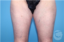 Nonsurgical Fat Reduction After Photo by Landon Pryor, MD, FACS; Rockford, IL - Case 41152