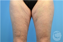 Nonsurgical Fat Reduction Before Photo by Landon Pryor, MD, FACS; Rockford, IL - Case 41152