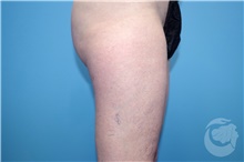 Nonsurgical Fat Reduction After Photo by Landon Pryor, MD, FACS; Rockford, IL - Case 41152
