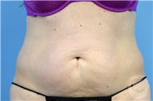 Nonsurgical Fat Reduction Before Photo by Landon Pryor, MD, FACS; Rockford, IL - Case 41173
