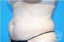 Nonsurgical Fat Reduction After Photo by Landon Pryor, MD, FACS; Rockford, IL - Case 41173
