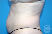 Nonsurgical Fat Reduction After Photo by Landon Pryor, MD, FACS; Rockford, IL - Case 41173