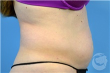 Nonsurgical Fat Reduction Before Photo by Landon Pryor, MD, FACS; Rockford, IL - Case 41173