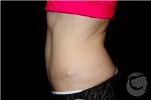 Nonsurgical Fat Reduction After Photo by Landon Pryor, MD, FACS; Rockford, IL - Case 41176