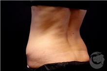 Nonsurgical Fat Reduction Before Photo by Landon Pryor, MD, FACS; Rockford, IL - Case 41176
