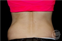 Nonsurgical Fat Reduction After Photo by Landon Pryor, MD, FACS; Rockford, IL - Case 41176