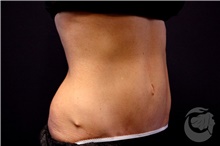 Nonsurgical Fat Reduction Before Photo by Landon Pryor, MD, FACS; Rockford, IL - Case 41176