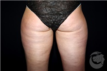 Nonsurgical Fat Reduction After Photo by Landon Pryor, MD, FACS; Rockford, IL - Case 41177