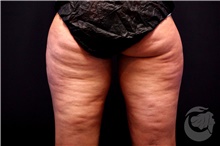 Nonsurgical Fat Reduction Before Photo by Landon Pryor, MD, FACS; Rockford, IL - Case 41177