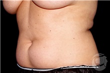 Nonsurgical Fat Reduction Before Photo by Landon Pryor, MD, FACS; Rockford, IL - Case 41179