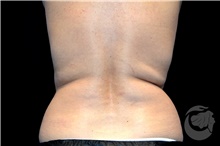 Nonsurgical Fat Reduction After Photo by Landon Pryor, MD, FACS; Rockford, IL - Case 41179