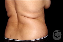 Nonsurgical Fat Reduction Before Photo by Landon Pryor, MD, FACS; Rockford, IL - Case 41179