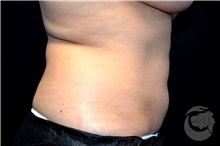 Nonsurgical Fat Reduction After Photo by Landon Pryor, MD, FACS; Rockford, IL - Case 41179