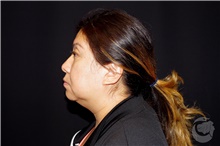 Nonsurgical Fat Reduction Before Photo by Landon Pryor, MD, FACS; Rockford, IL - Case 41180