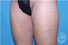 Nonsurgical Fat Reduction After Photo by Landon Pryor, MD, FACS; Rockford, IL - Case 41182