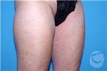 Nonsurgical Fat Reduction After Photo by Landon Pryor, MD, FACS; Rockford, IL - Case 41182