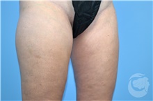 Nonsurgical Fat Reduction Before Photo by Landon Pryor, MD, FACS; Rockford, IL - Case 41182