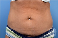 Nonsurgical Fat Reduction Before Photo by Landon Pryor, MD, FACS; Rockford, IL - Case 41203