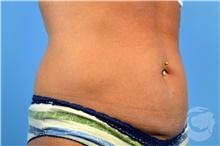 Nonsurgical Fat Reduction Before Photo by Landon Pryor, MD, FACS; Rockford, IL - Case 41203