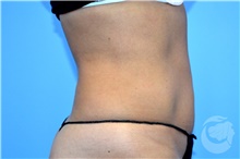 Nonsurgical Fat Reduction After Photo by Landon Pryor, MD, FACS; Rockford, IL - Case 41203