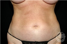Nonsurgical Fat Reduction After Photo by Landon Pryor, MD, FACS; Rockford, IL - Case 41205