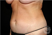 Nonsurgical Fat Reduction After Photo by Landon Pryor, MD, FACS; Rockford, IL - Case 41205