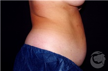 Nonsurgical Fat Reduction Before Photo by Landon Pryor, MD, FACS; Rockford, IL - Case 41205
