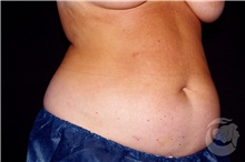 Nonsurgical Fat Reduction Before Photo by Landon Pryor, MD, FACS; Rockford, IL - Case 41205