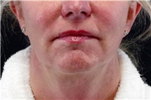 Nonsurgical Fat Reduction After Photo by Landon Pryor, MD, FACS; Rockford, IL - Case 41206