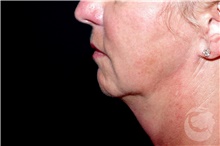 Nonsurgical Fat Reduction Before Photo by Landon Pryor, MD, FACS; Rockford, IL - Case 41206