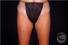 Nonsurgical Fat Reduction Before Photo by Landon Pryor, MD, FACS; Rockford, IL - Case 41207