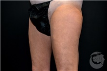 Nonsurgical Fat Reduction After Photo by Landon Pryor, MD, FACS; Rockford, IL - Case 41207