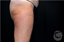 Nonsurgical Fat Reduction After Photo by Landon Pryor, MD, FACS; Rockford, IL - Case 41207