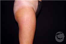 Nonsurgical Fat Reduction Before Photo by Landon Pryor, MD, FACS; Rockford, IL - Case 41207