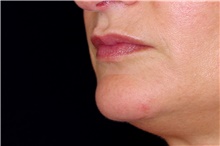 Lip Augmentation/Enhancement Before Photo by Landon Pryor, MD, FACS; Rockford, IL - Case 43030