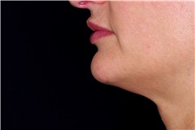 Lip Augmentation/Enhancement After Photo by Landon Pryor, MD, FACS; Rockford, IL - Case 43030