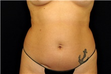 Liposuction Before Photo by Landon Pryor, MD, FACS; Rockford, IL - Case 43031